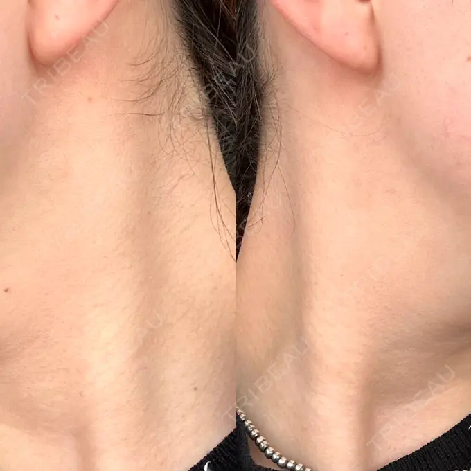 ボトックス（エラ・小顔） Natural Skin Clinic 自由ヶ丘院 BEFORE メイン用