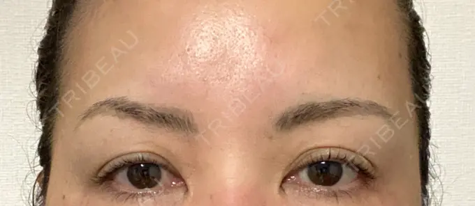 アートメイク（眉） REDLINE CLINIC BEFORE メイン用