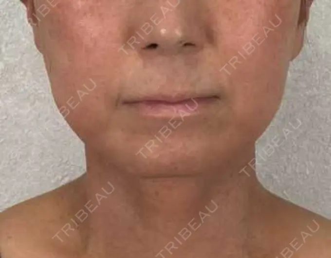 糸リフト / ボトックス（エラ・小顔） / ピーリング（ハリ・ツヤ） アリエル美容クリニック 横浜院 BEFORE メイン用