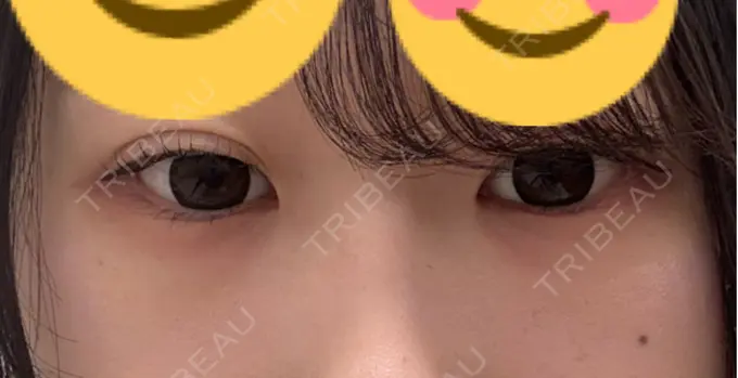 ヒアルロン酸注入（涙袋） フィラークリニック 大阪心斎橋院 BEFORE メイン用