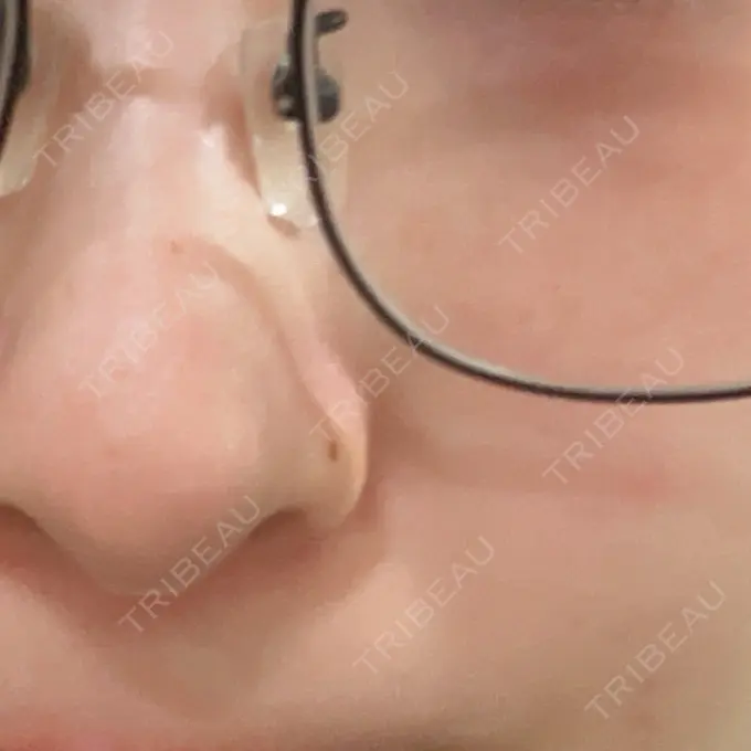 ルメッカ ルラ美容クリニック 岡山院 BEFORE メイン用