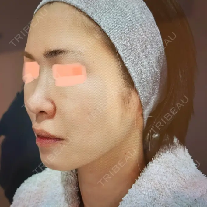 隆鼻術 / 軟骨移植 / 毛穴洗浄（ハイドラフェイシャルなど） / その他（鼻） BIANCA銀座 BEFORE メイン用