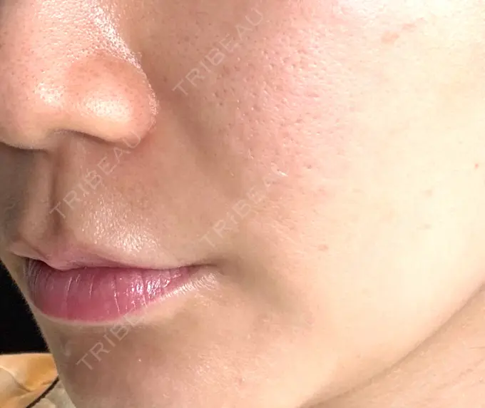 サブシジョン コスメディカルクリニック シンシア 渋谷院 BEFORE メイン用