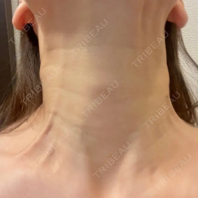 ボトックス（首） THE FIRST CLINIC 多摩センター院 BEFORE メイン用