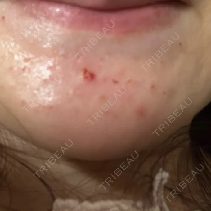 アグネス オラクル美容皮膚科 福岡天神院 BEFORE メイン用