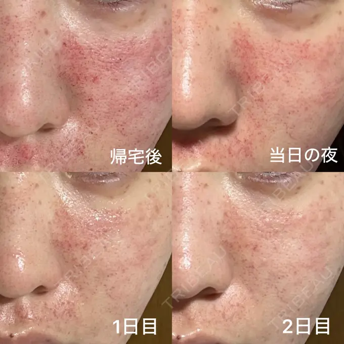 肌育注射（ジュベルックなど） / シミ取りレーザー / ピコレーザートーニング（美白・肝斑） / ピコフラクショナルレーザー（毛穴・ニキビ跡） 東京シルククリニック 新宿院 BEFORE メイン用