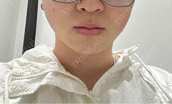 ボトックス（額） TCB東京中央美容外科 越谷院 BEFORE メイン用