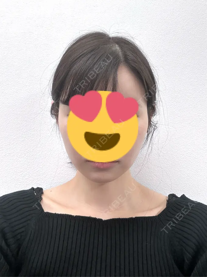 糸リフト / 脂肪吸引（顔） Mods Clinic（モッズクリニック） 名古屋院 BEFORE メイン用