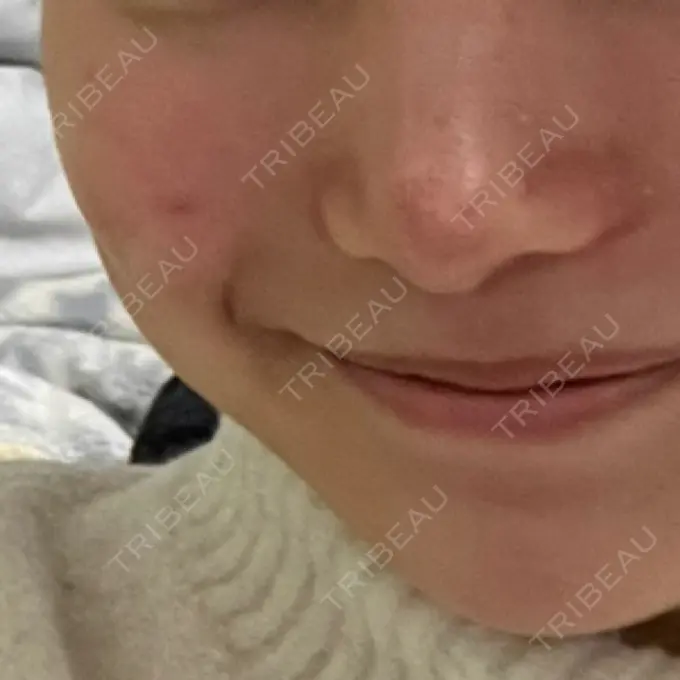 肌育注射（ジュベルックなど） 城本クリニック 池袋院 BEFORE メイン用