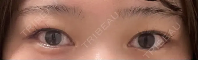 眉下切開 もとび美容外科クリニック 新宿院 BEFORE メイン用