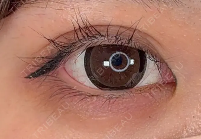 ヒアルロン酸注入（涙袋） / ヒアルロン酸注入（唇） / ボトックス（タレ目） アリエル美容クリニック 横浜院 BEFORE メイン用