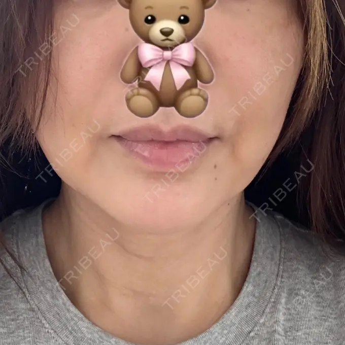 RF（高周波）たるみ治療 PureMe Skin Clinic（ピュアミースキンクリニック麻布） BEFORE メイン用