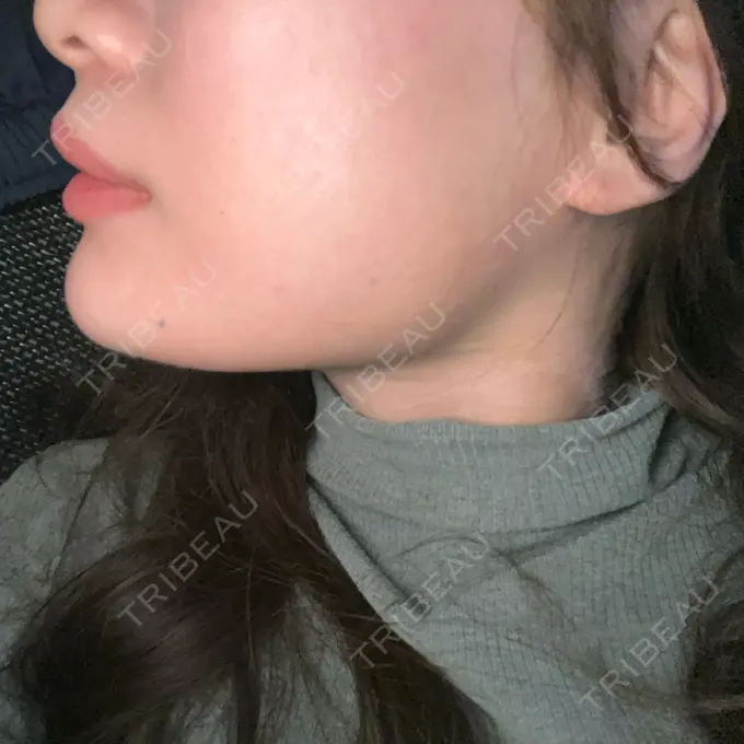 ヒアルロン酸注入（あご） / ボトックス（エラ・小顔） フィラークリニック 名古屋栄院 BEFORE メイン用