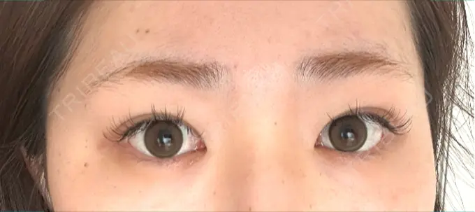 眉下切開 PRO CLINIC プロクリニック 銀座院 BEFORE メイン用