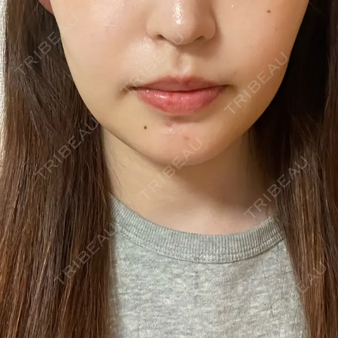 ボトックス（エラ・小顔） もとび美容外科クリニック 新宿院 BEFORE メイン用