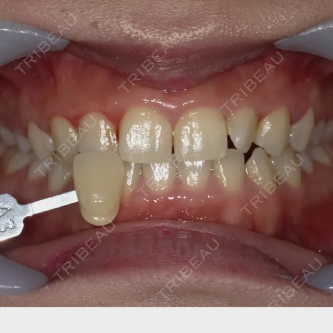 ホワイトニング 東京美容外科 赤坂院 BEFORE メイン用