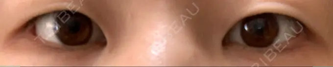 二重埋没 湘南美容クリニック 京都院 BEFORE メイン用