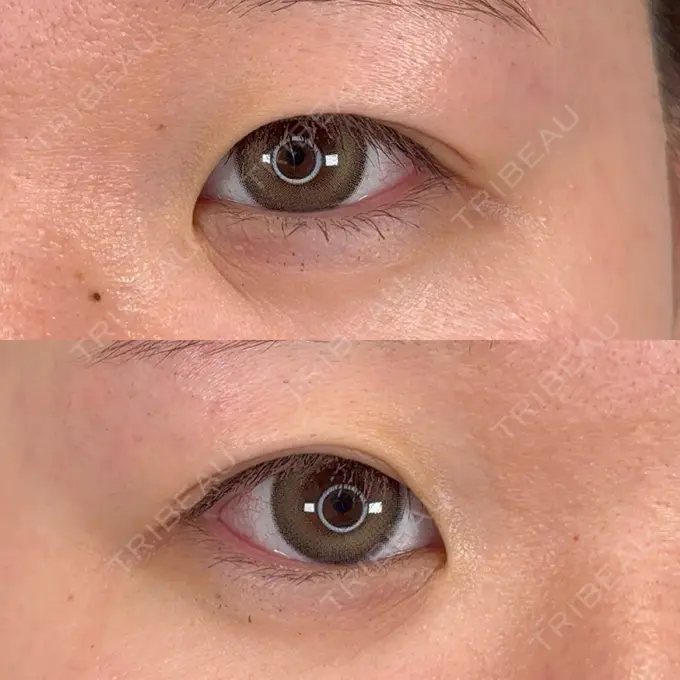 二重埋没 / ヒアルロン酸注入（涙袋） アリエル美容クリニック 横浜院 BEFORE メイン用