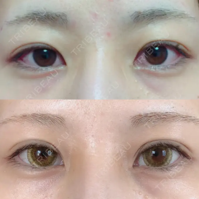 二重切開 / 上まぶたの脂肪取り / その他（目元） 銀座高須クリニック BEFORE メイン用