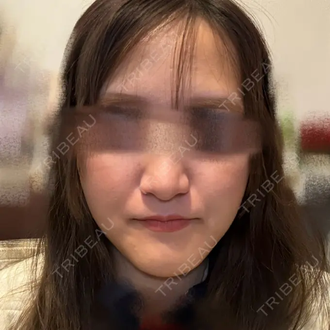 骨切り（あご） 銀座マイアミ美容外科 BEFORE メイン用