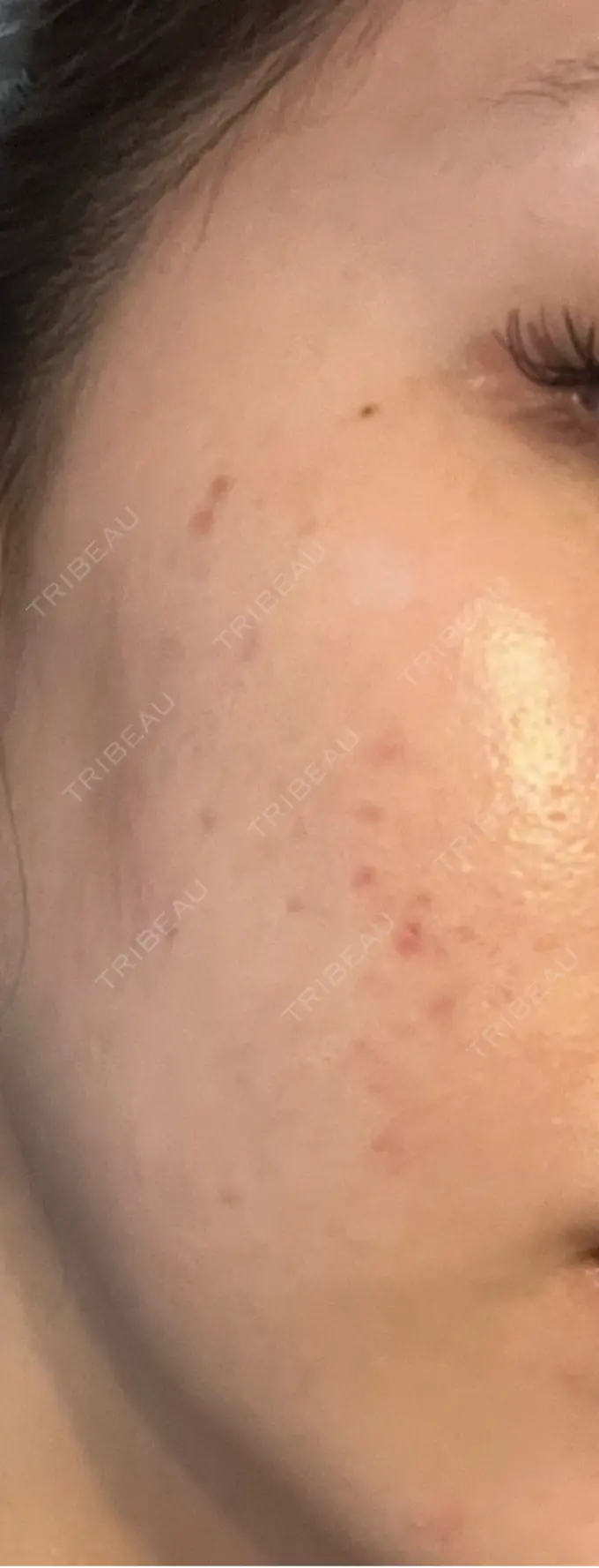 ピーリング（ハリ・ツヤ） / ルメッカ 大美会クリニック 梅田院 BEFORE メイン用