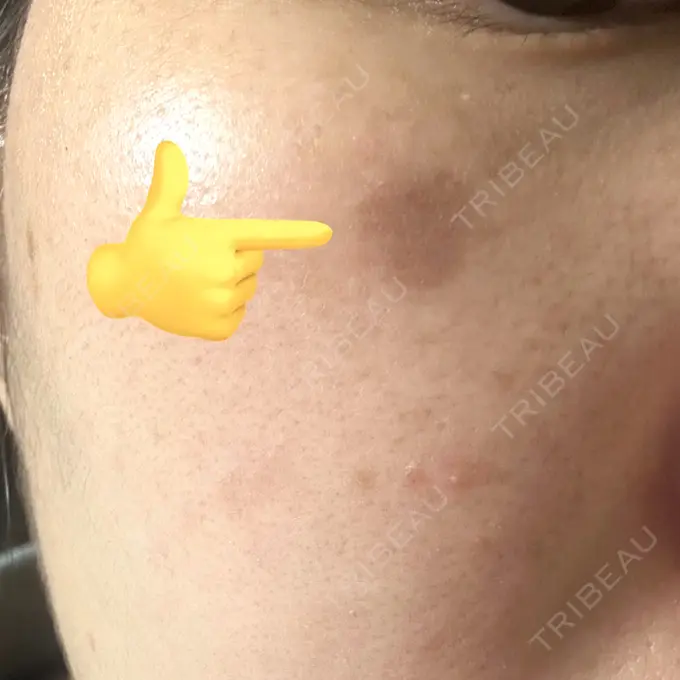 ボトックス（あご） / ピーリング（ニキビ・毛穴） / ルメッカ ルラ美容クリニック 大阪心斎橋院 BEFORE メイン用