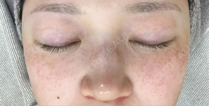 光治療（フォトフェイシャルなど） 城本クリニック 大宮院 BEFORE メイン用