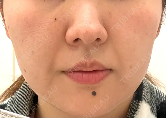 ピーリング（ニキビ・毛穴） / ピコレーザートーニング（美白・肝斑） / フラクショナルレーザー（毛穴・ニキビ跡） / ピコスポット BISIN GINZA CLINIC BEFORE メイン用