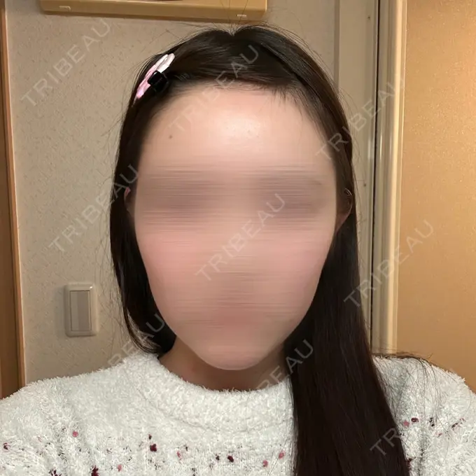 糸リフト 東京シンデレラ美容外科 池袋院 BEFORE メイン用