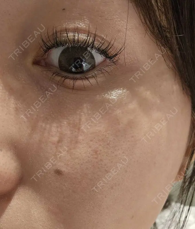 その他（目元） ネビュラクリニック 広島院 BEFORE メイン用