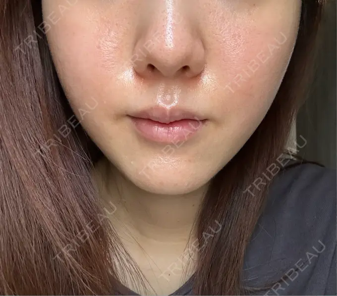 肌育注射（ジュベルックなど） 城本クリニック 新宿院 BEFORE メイン用