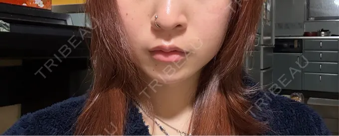 糸リフト / 脂肪吸引（顔） / 脂肪吸引注射（顔） ziz CLINIC BEFORE メイン用