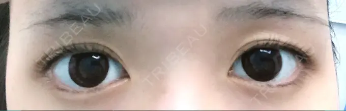 眉下切開 / その他（目元） 湘南美容クリニック 秋葉原院 BEFORE メイン用