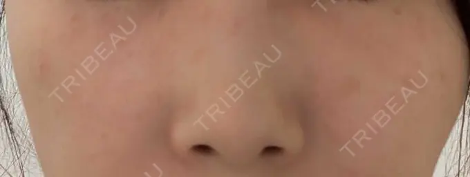 ニードルRF（ポテンツァなど） KM新宿クリニック BEFORE メイン用