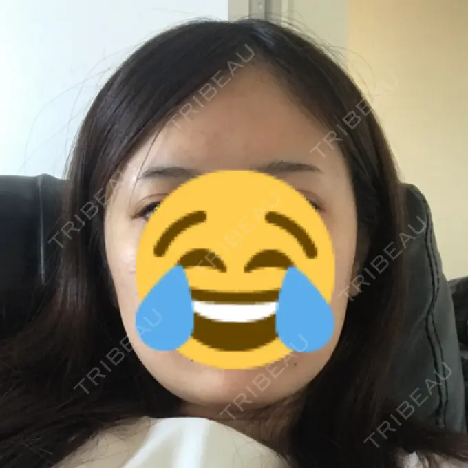 ボトックス（エラ・小顔） ルラ美容クリニック 高田馬場院 BEFORE メイン用