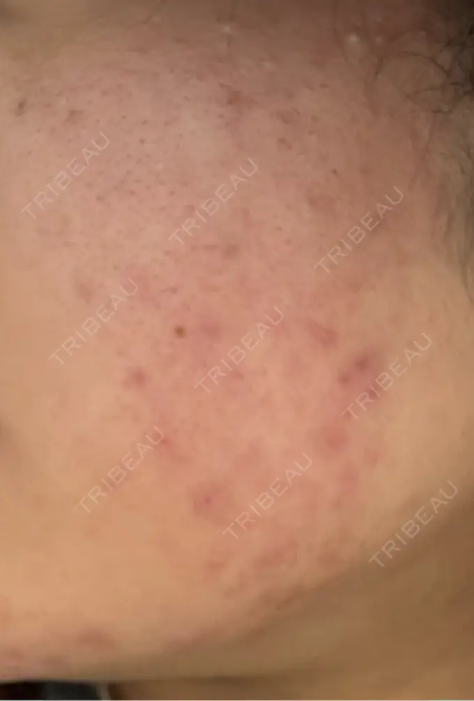 毛穴洗浄（ハイドラフェイシャルなど） / リジュラン 表参道ウィズ・クリニック BEFORE メイン用