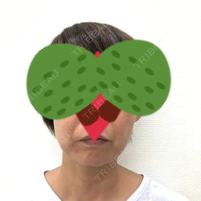 糸リフト / バッカルファット除去 / 肌ヒアルロン酸注入（たるみ・シワ改善） 大阪TAクリニック BEFORE メイン用