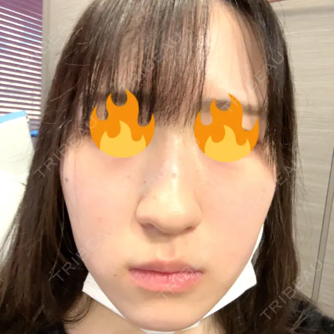 毛穴洗浄（ハイドラフェイシャルなど） / 光治療（フォトフェイシャルなど） 日比谷セントラルクリニック BEFORE メイン用