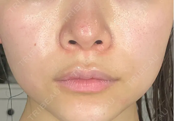 ルメッカ ハナビューティークリニック BEFORE メイン用