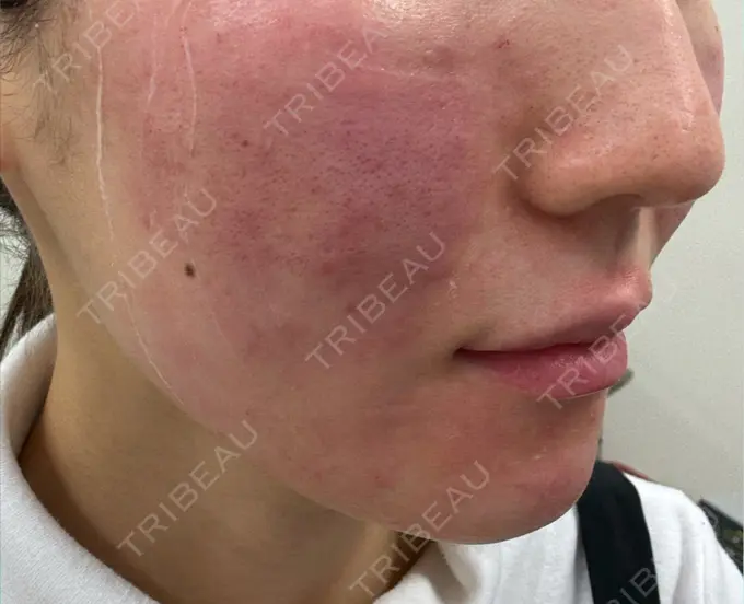 肌育注射（ジュベルックなど） 城本クリニック 池袋院 BEFORE メイン用