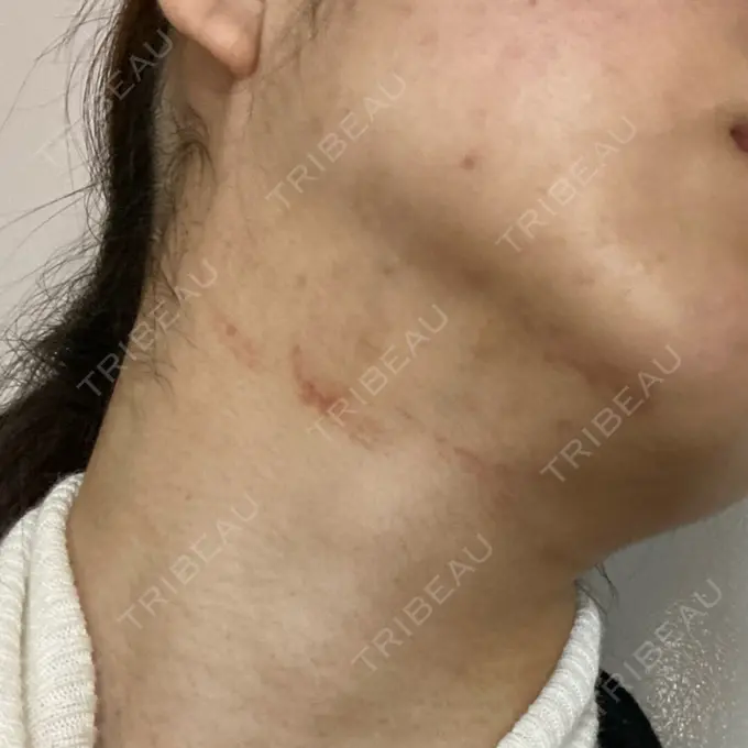 医療痩身（顔） / ボトックス（エラ・小顔） Chloe Cheongdam Clinic （クロエチョンダムクリニック） BEFORE メイン用