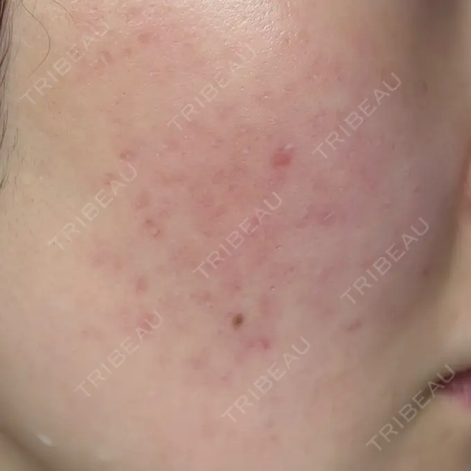 ピーリング（ニキビ・毛穴） / ルメッカ Grias clinic （ジリアスクリニック） BEFORE メイン用