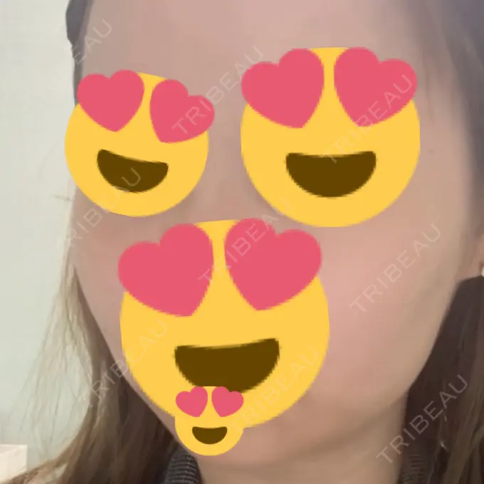 その他（輪郭） ルラ美容クリニック 名古屋本院 BEFORE メイン用