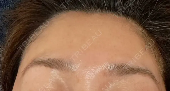 ピーリング（ニキビ・毛穴） / エレクトロポレーション / ピーリング（ハリ・ツヤ） SK新宿歌舞伎町美容外科・歯科 BEFORE メイン用