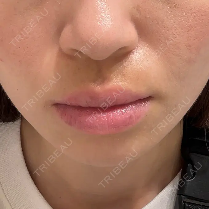 ヒアルロン酸注入（頬） / ヒアルロン酸注入（鼻翼基部） KIMI CLINIC 形成・美容外科 BEFORE メイン用