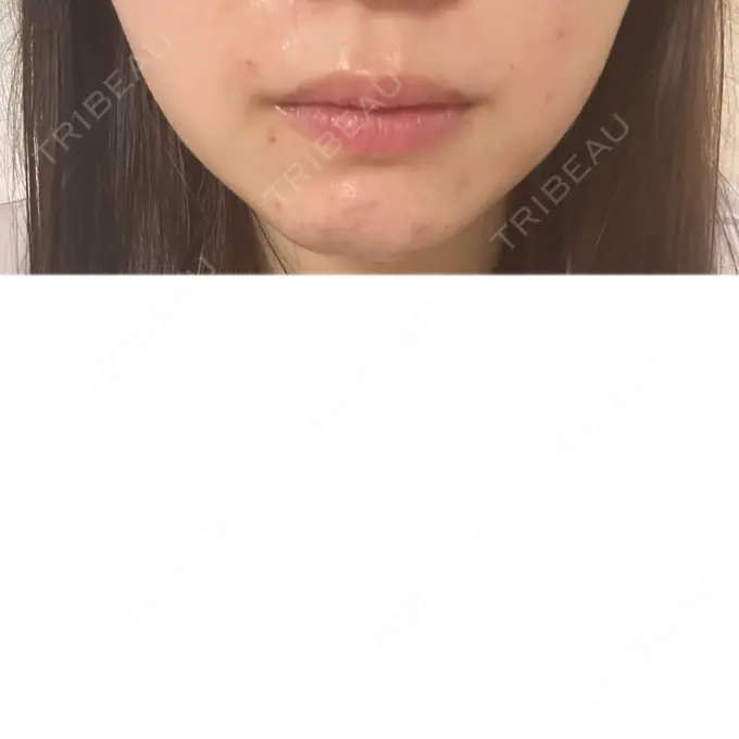 ニードルRF（ポテンツァなど） / アグネス 日本ウェルネス再生クリニック BEFORE メイン用