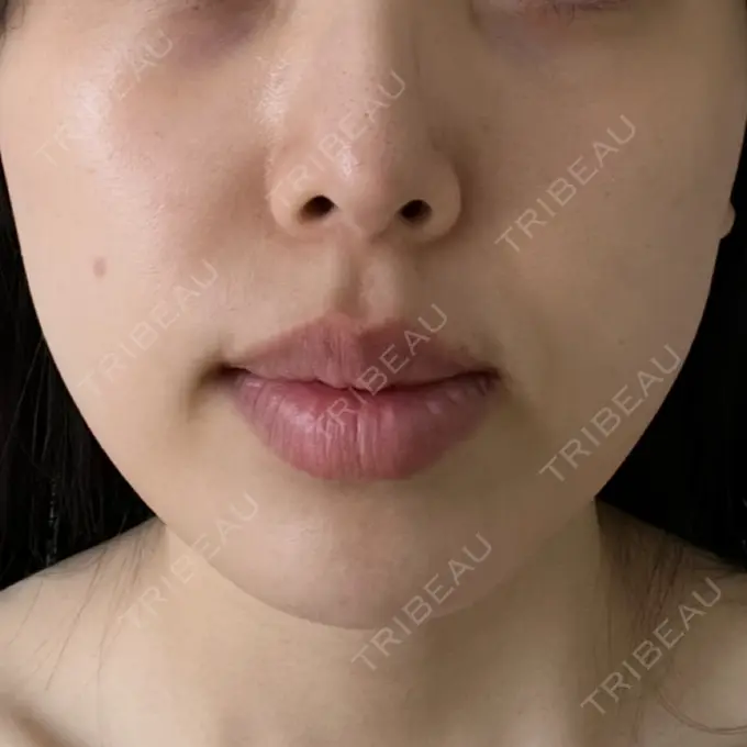 糸リフト / 脂肪吸引（顔） / 脂肪注入（目の下） / ボトックス（あご） / ボトックス（エラ・小顔） / ボトックス（口角） / ボトックス（眉間） 東京ココセランクリニック BEFORE メイン用