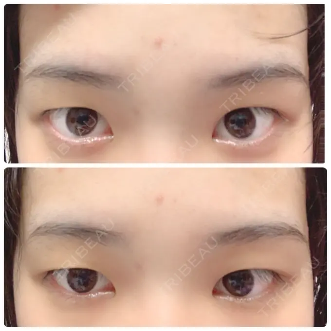 二重埋没 金沢中央クリニック BEFORE メイン用