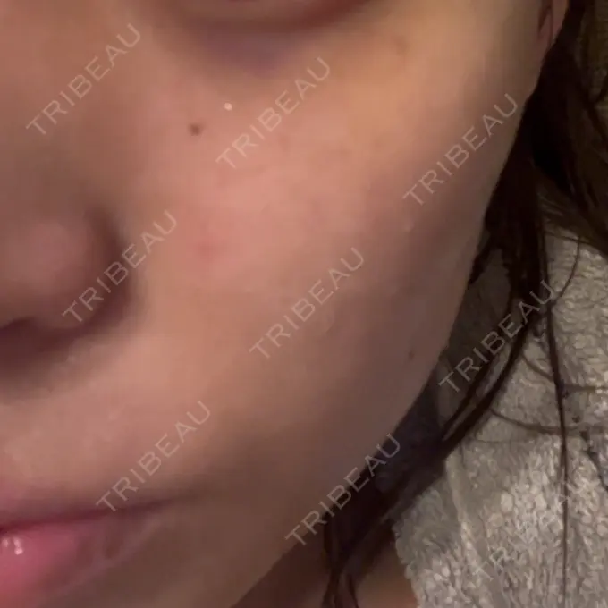 ピーリング（ニキビ・毛穴） / ピコレーザートーニング（美白・肝斑） RainBoW Clinic TOKYO BEFORE メイン用