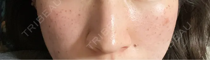 エレクトロポレーション / ピーリング（ハリ・ツヤ） / ルメッカ Otus Clinic 【オータスクリニック】 BEFORE メイン用